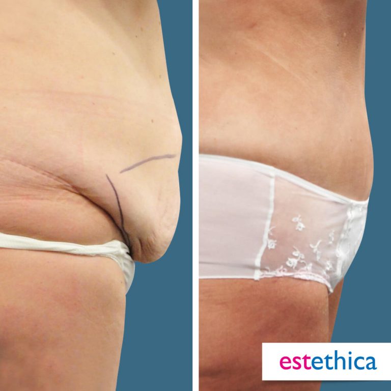Abdominoplasty_OnceSonra_1.jpg