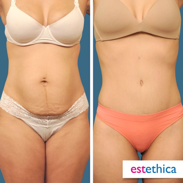 Abdominoplasty_OnceSonra_2.jpg
