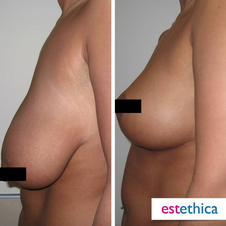 Breast-Lift-3.jpg