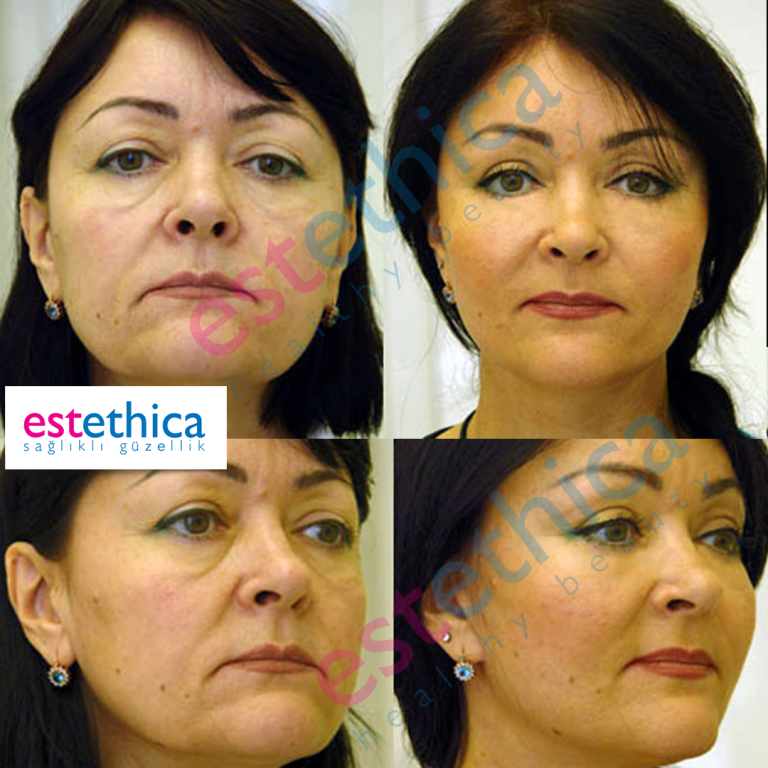 Face-Lift-W-1.png