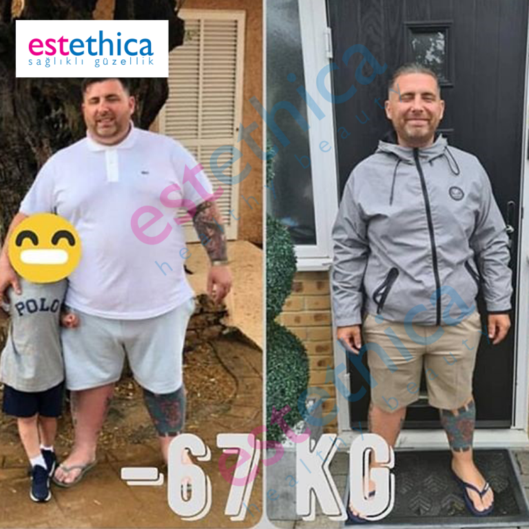 Gastric-Sleeve-1-M.png