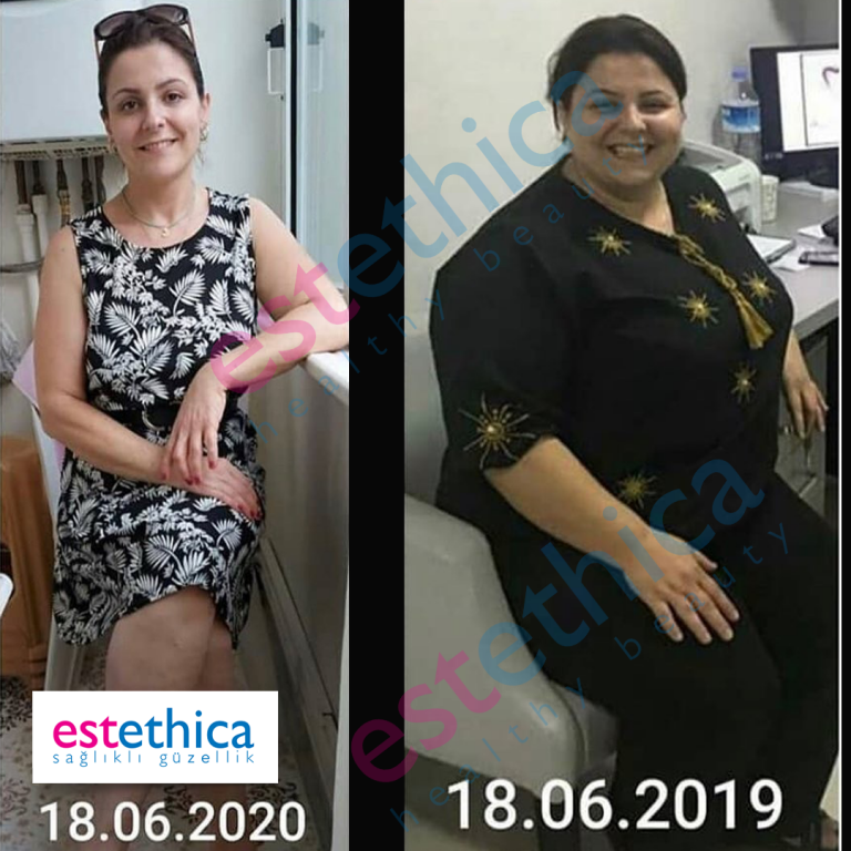 Gastric-Sleeve-1-W.png