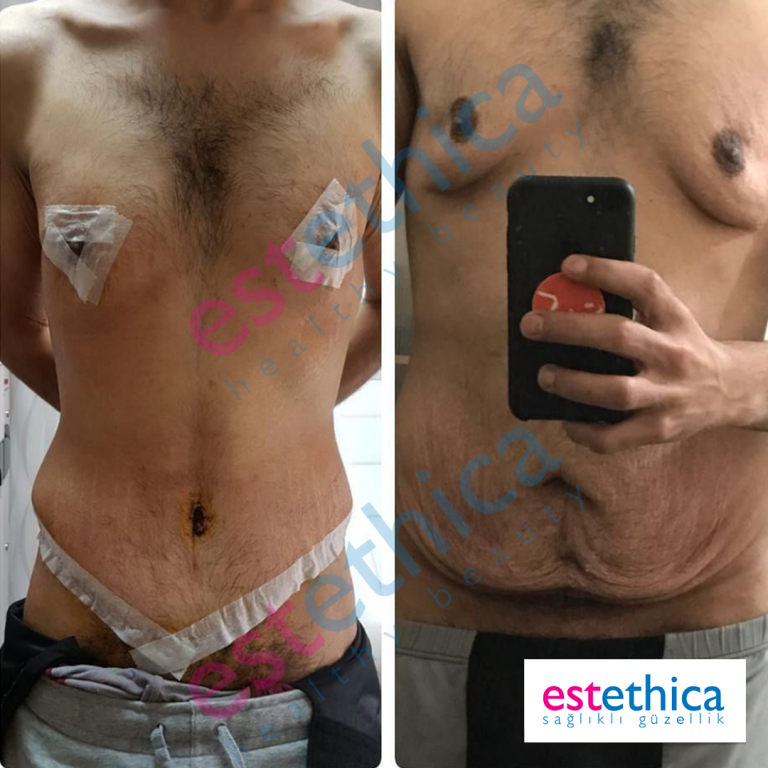 Abdo-+-Gyneco