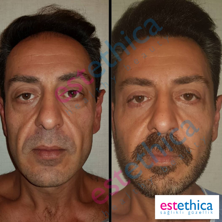 Face-Lif-Surgical-7.png