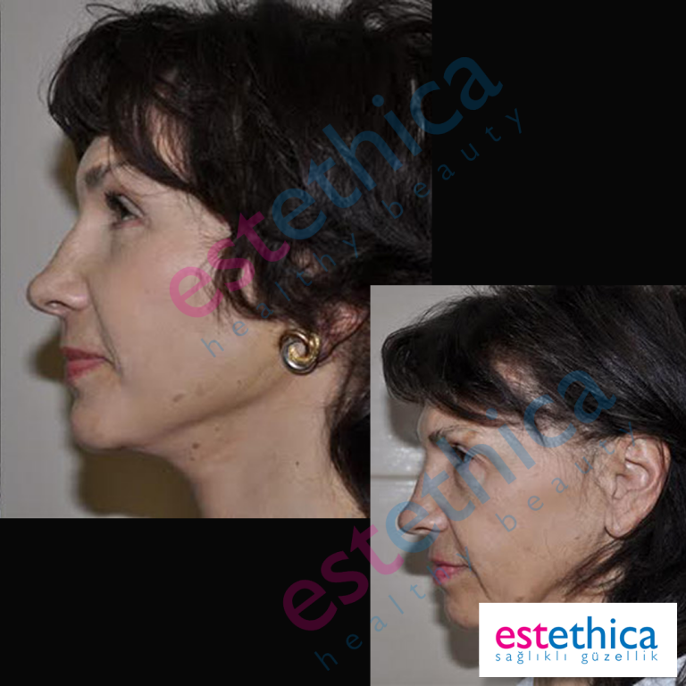 Face-Lift-W-4.png