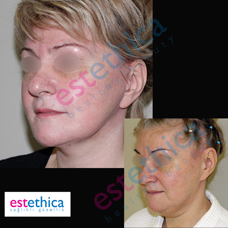 Face-Lift-W-5.png