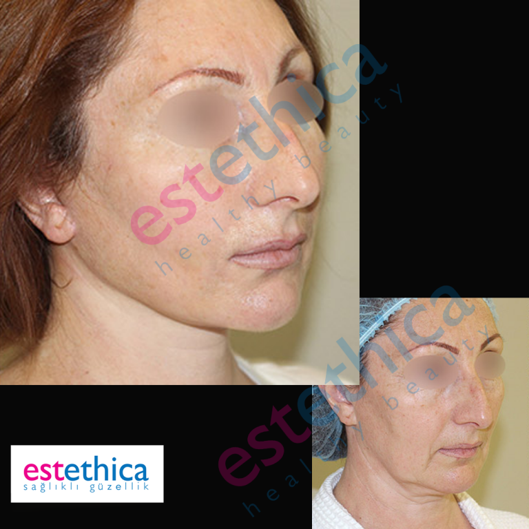 Face-Lift-W-6.png
